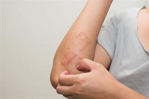 allergy sa sabon panlaba|Mga uri ng allergy sa balat: Heto ang dapat mong malaman.